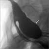 Zenker Diverticulum in a 72-Year-Old Man