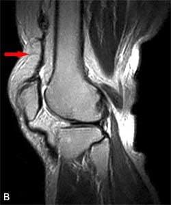 Quadriceps Tendinosis With Partial Tear