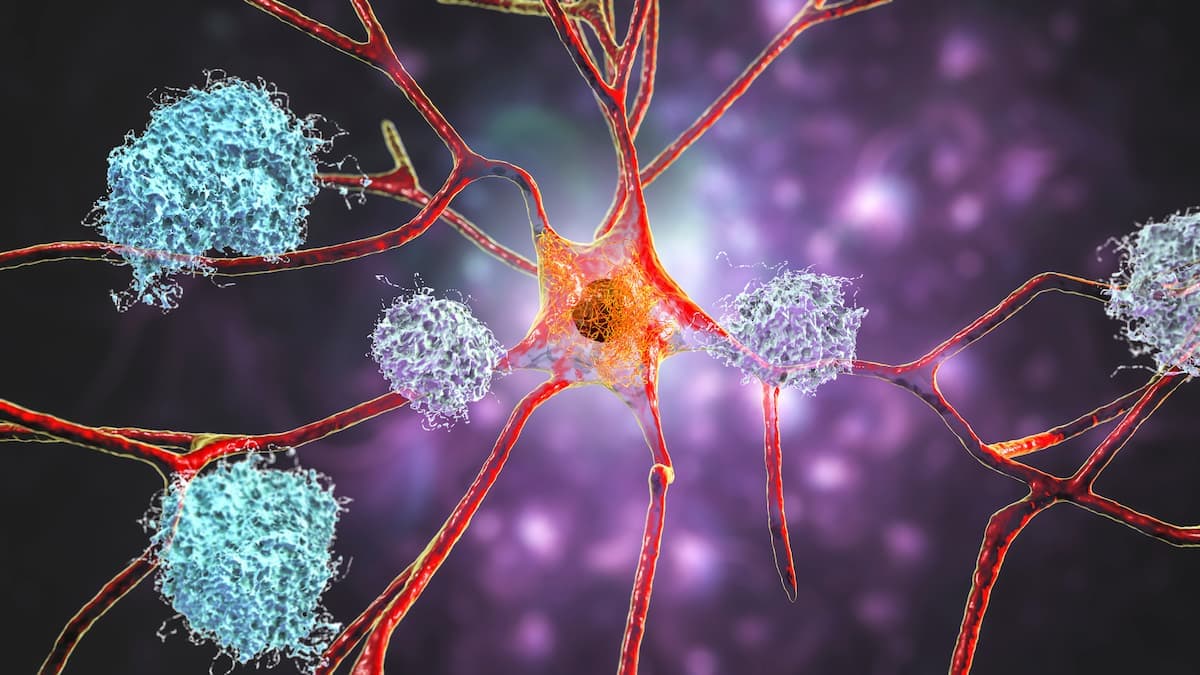 Modified Donanemab Dosing Reduces ARIA-E in Adults with Early Symptomatic Alzheimer Disease / Image credit: ©Dr_Microbe/AdobeStock