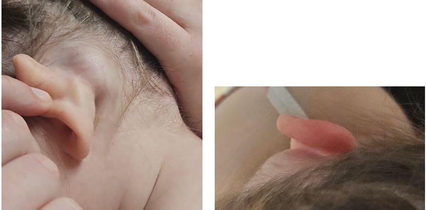 Swelling behind the ear : Seen in the ED 