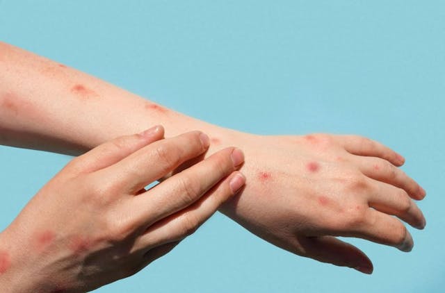 Mpox Outbreak: 5 Things to Know if Patients Ask / image credit  ©Marina Demikiuk/stock.adobe.com