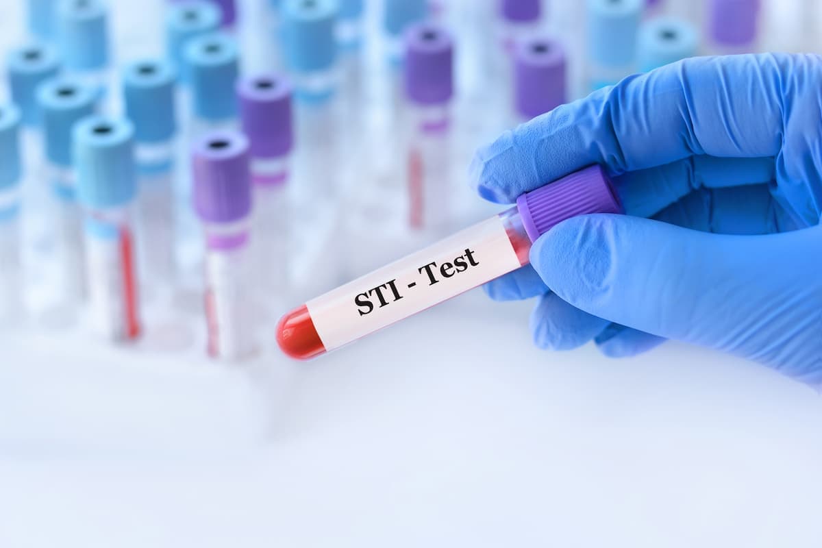 STI Epidemic in US Shows Signs of Slowing, According to New CDC Report / STI test Image credit: ©syhin_stas/AdobeStock